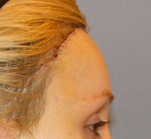 Hair Line Lowering