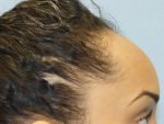Hair Line Lowering
