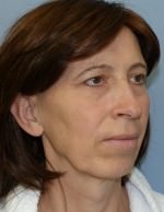 Facial Feminisation Surgery
