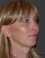 Facial Feminisation Surgery