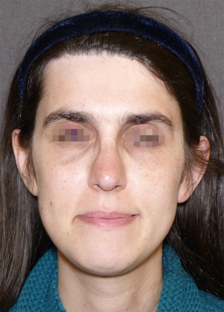 Facial Feminisation Surgery