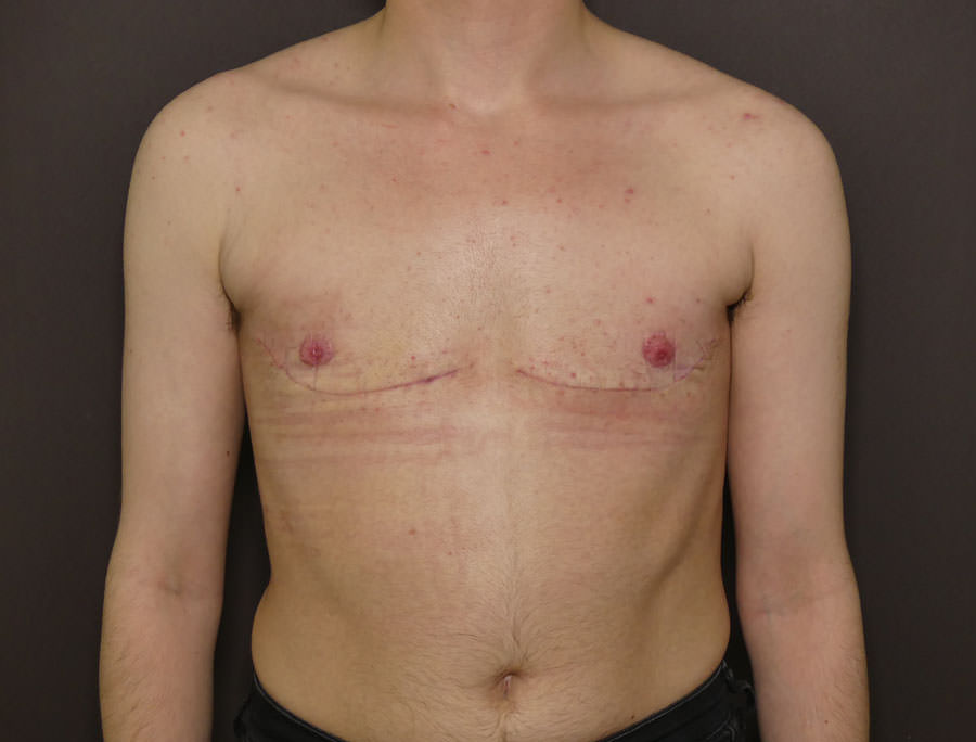 FtM Top Surgery