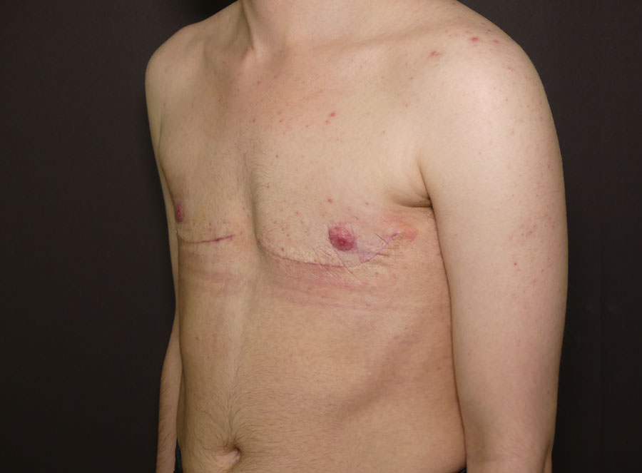 FtM Top Surgery
