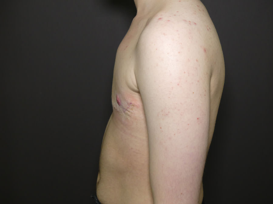 FtM Top Surgery