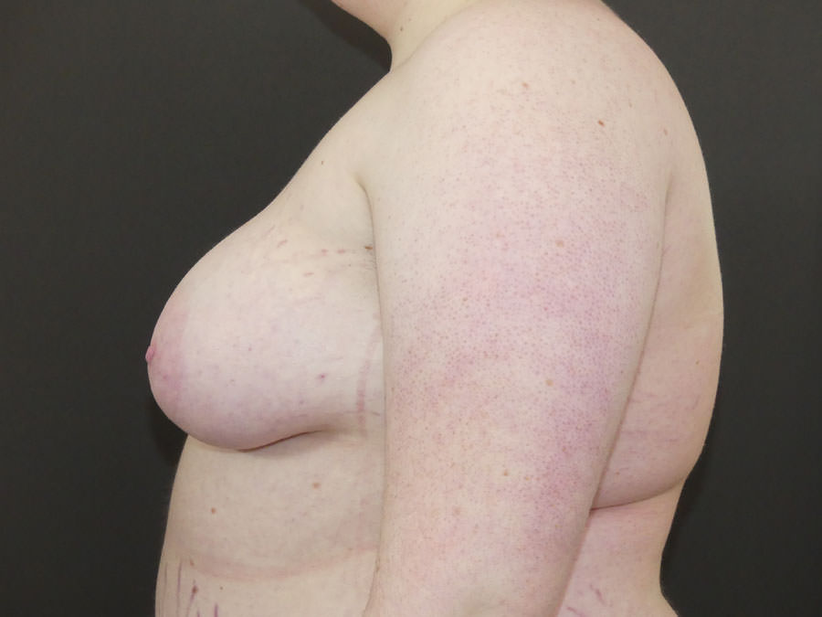 FtM Top Surgery