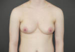 FtM Top Surgery