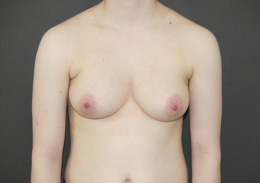 FtM Top Surgery
