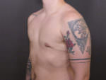 FtM Top Surgery