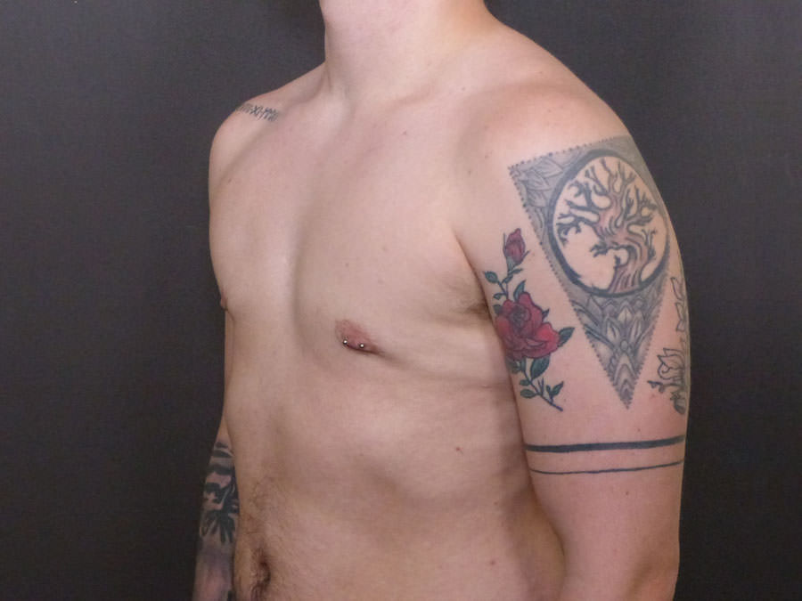 FtM Top Surgery