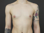 FtM Top Surgery