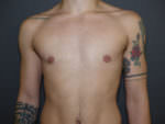 FtM Top Surgery