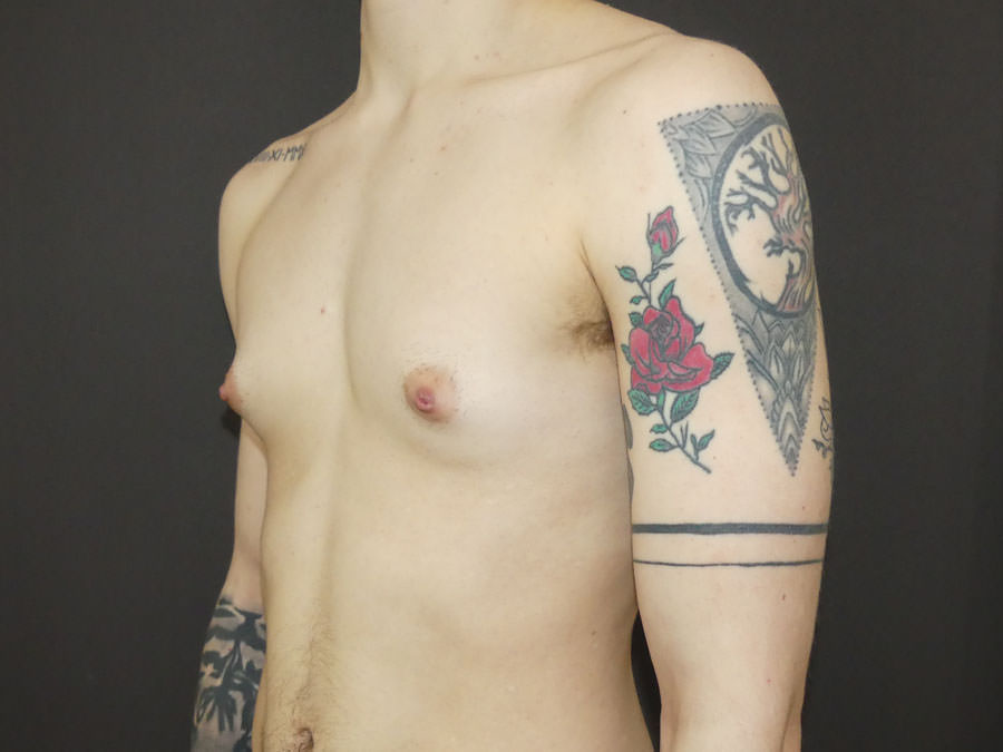 FtM Top Surgery