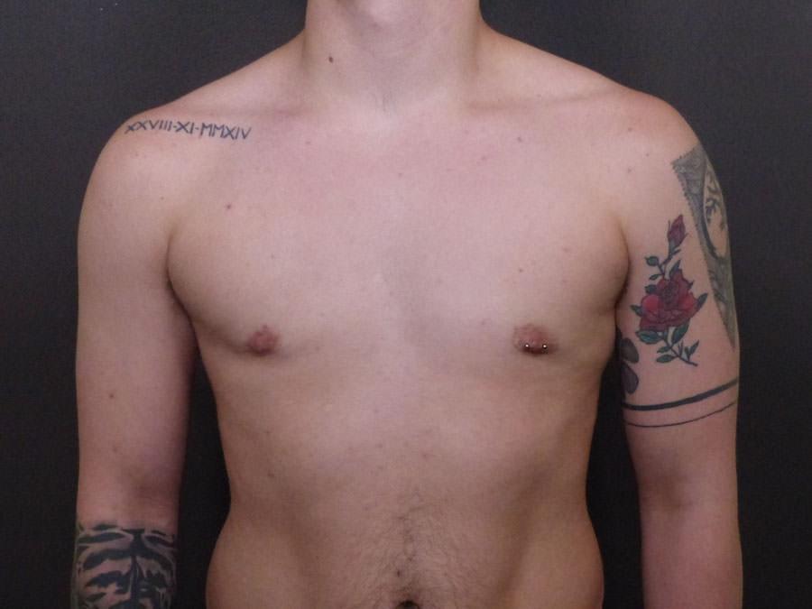 FtM Top Surgery