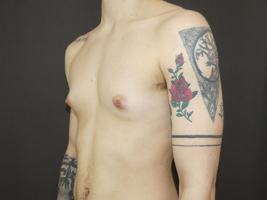 FtM Top Surgery