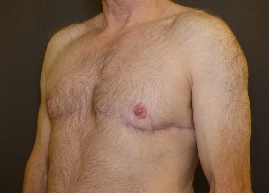 Revision Top Surgery