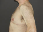 Revision Top Surgery