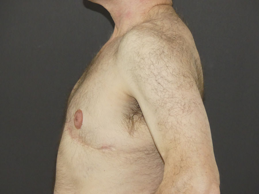 Revision Top Surgery