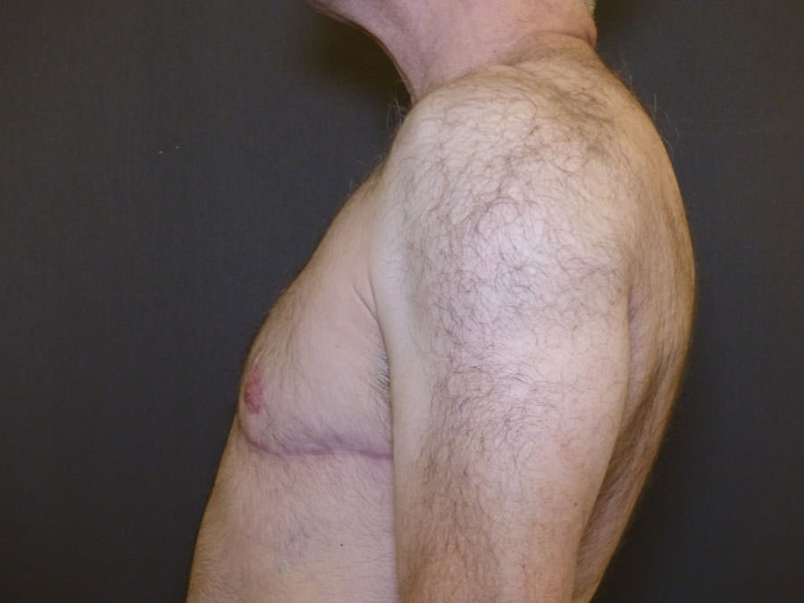 Revision Top Surgery