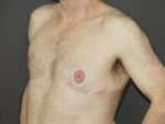 Revision Top Surgery