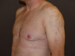 Revision Top Surgery