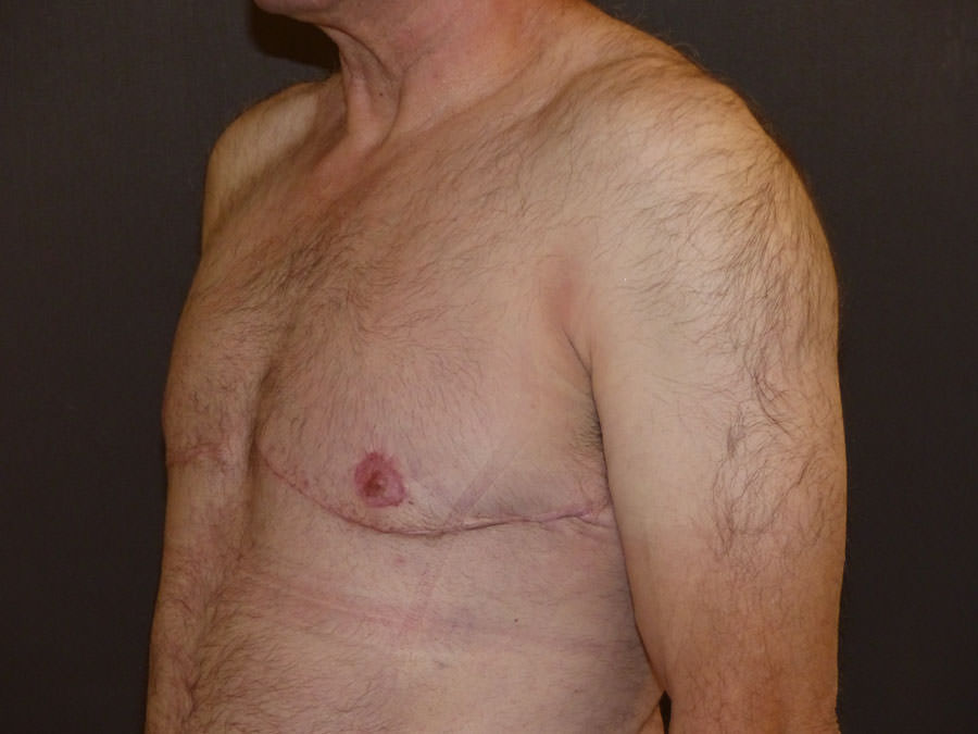 Revision Top Surgery