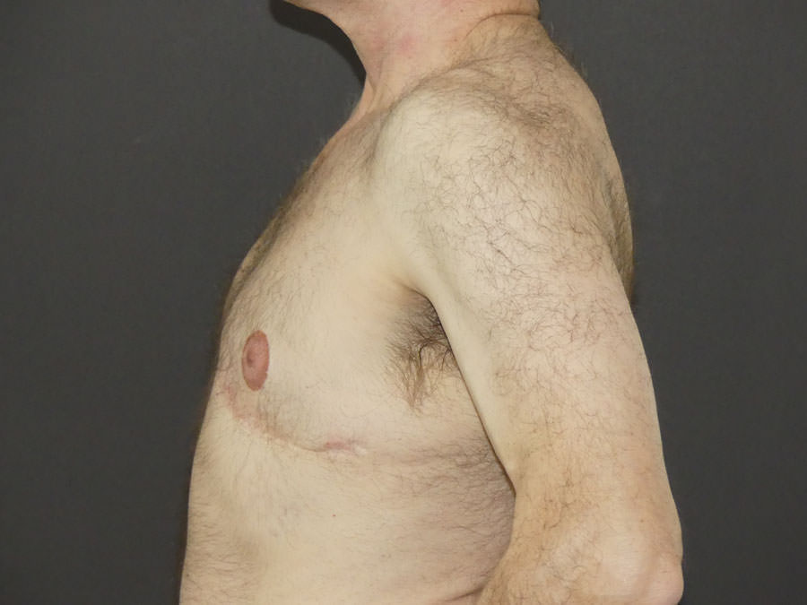 Revision Top Surgery