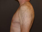 Revision Top Surgery