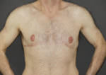 Revision Top Surgery