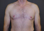 Revision Top Surgery