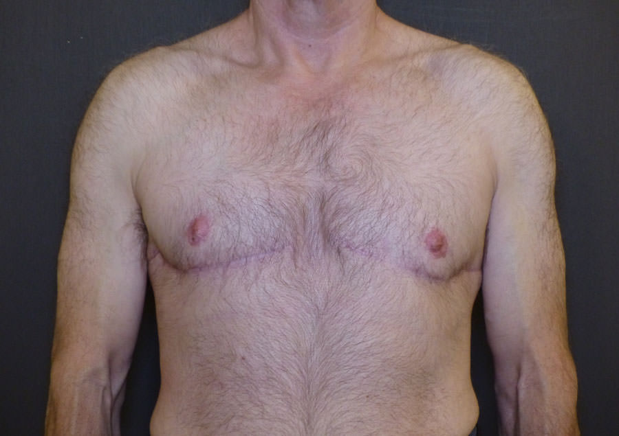 Revision Top Surgery
