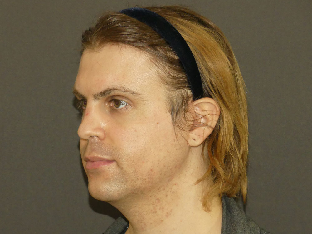 Facial Feminisation Surgery