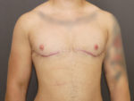 FtM Top Surgery