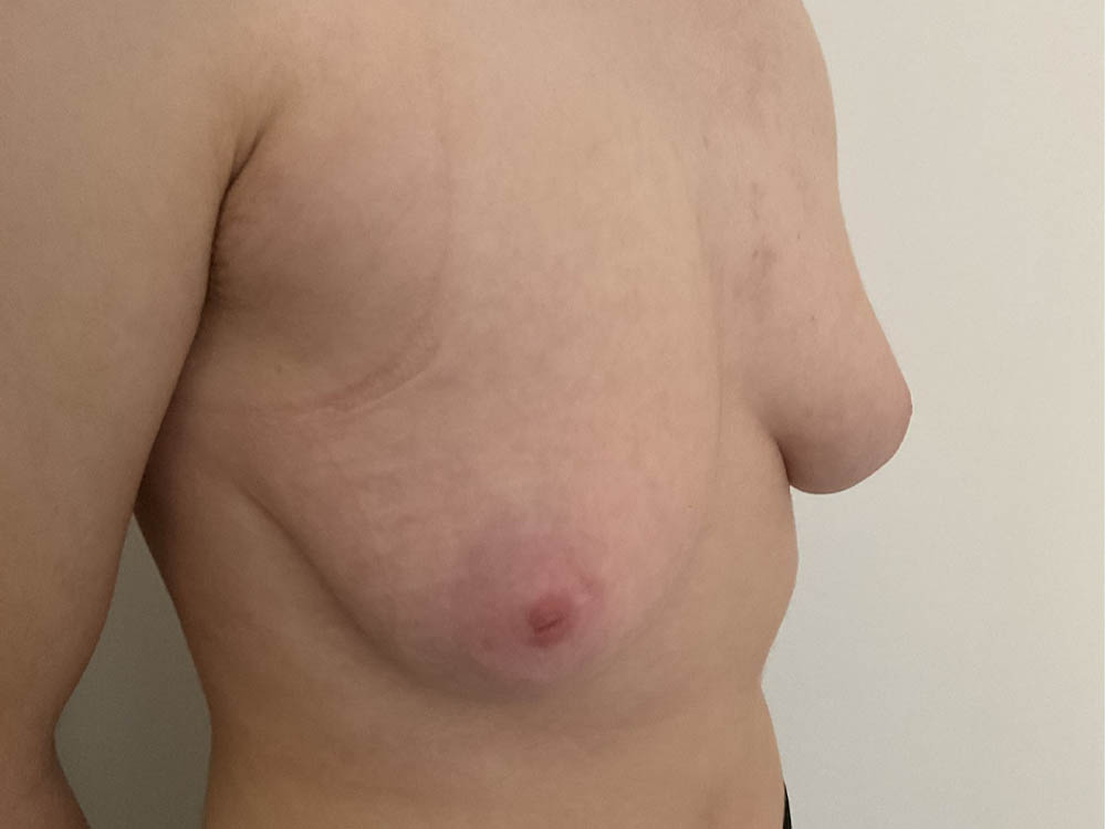 FtM Top Surgery
