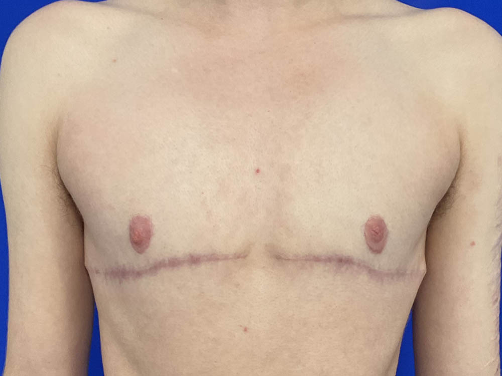 FtM Top Surgery
