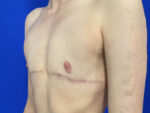 FtM Top Surgery