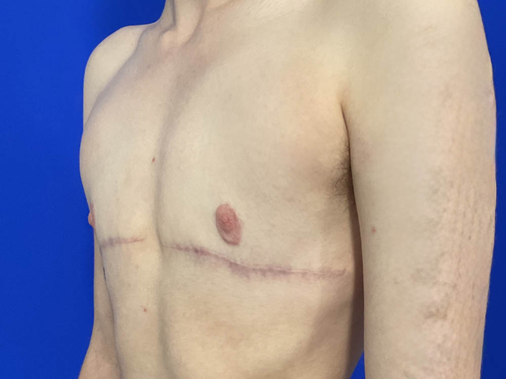 FtM Top Surgery