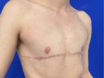 FtM Top Surgery