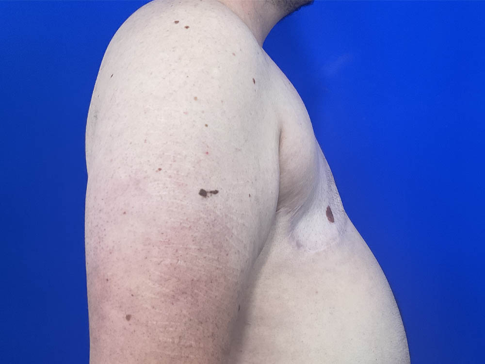 FtM Top Surgery