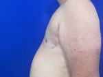 FtM Top Surgery