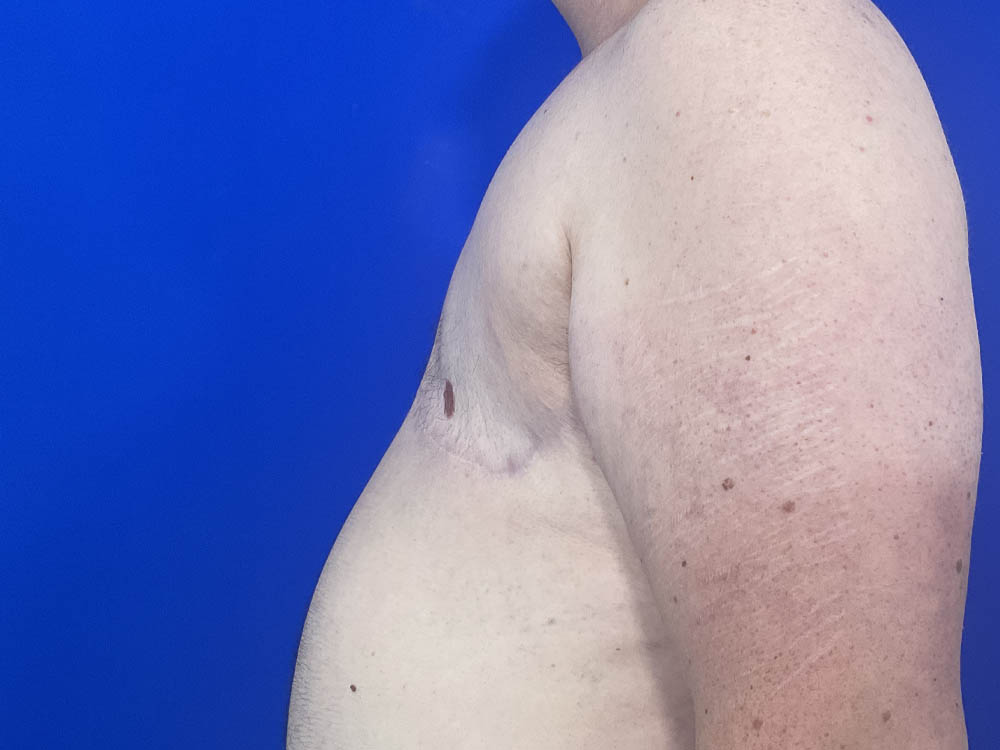 FtM Top Surgery